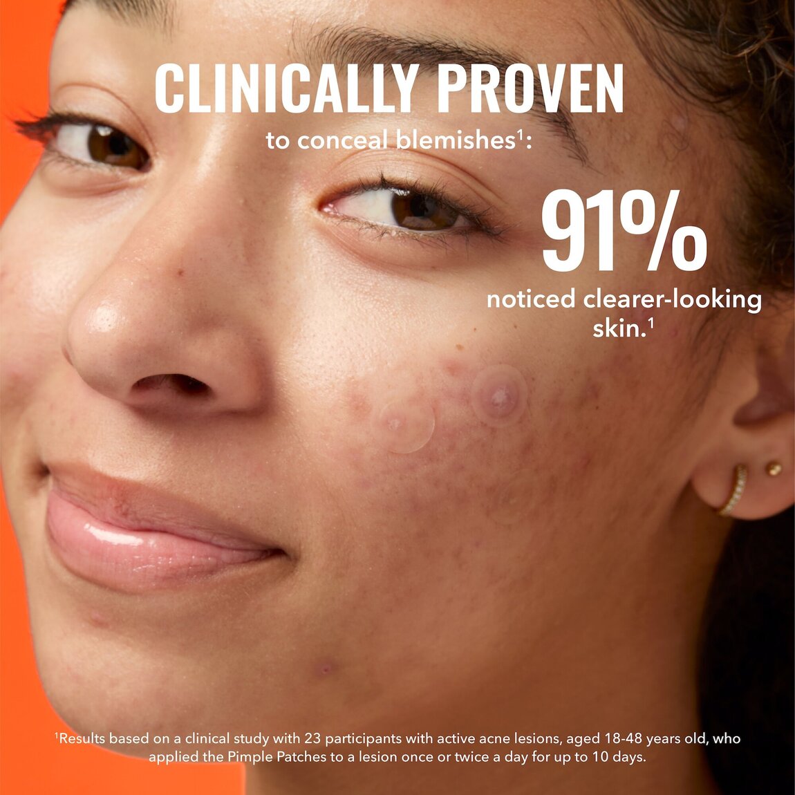 pimple-patches-n4 zb_p.jpg